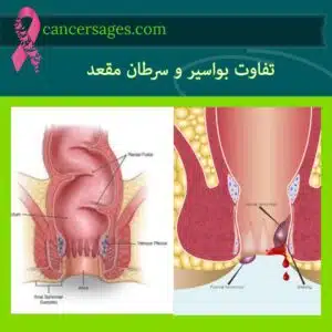 تفاوت بواسیر و سرطان مقعد