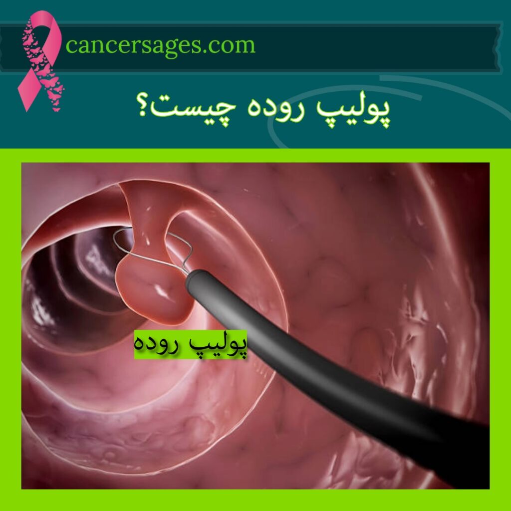پولیپ روده