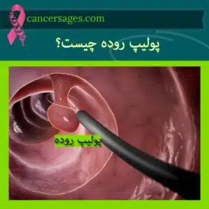 پولیپ روده