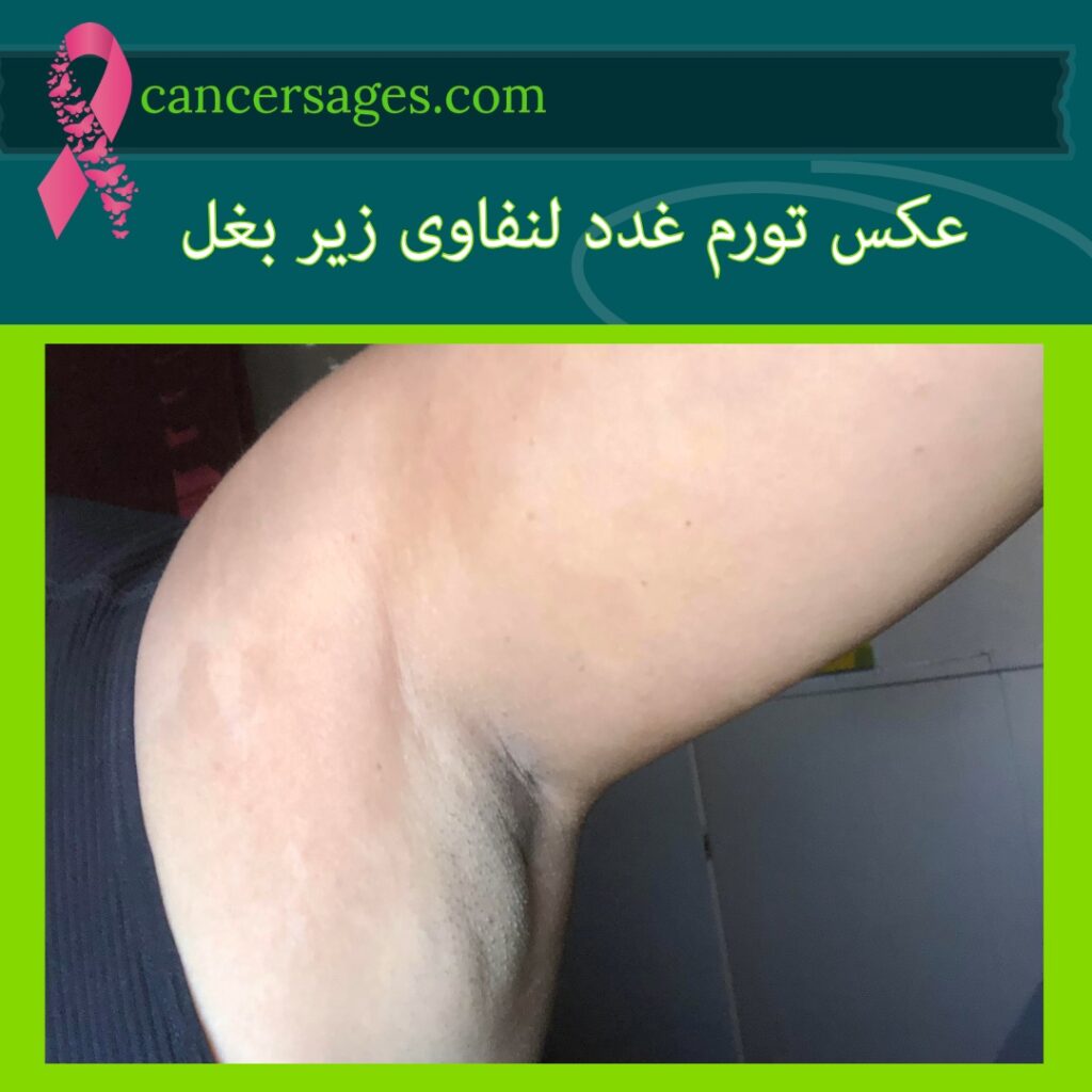 عکس تورم غدد لنفاوی زیر بغل