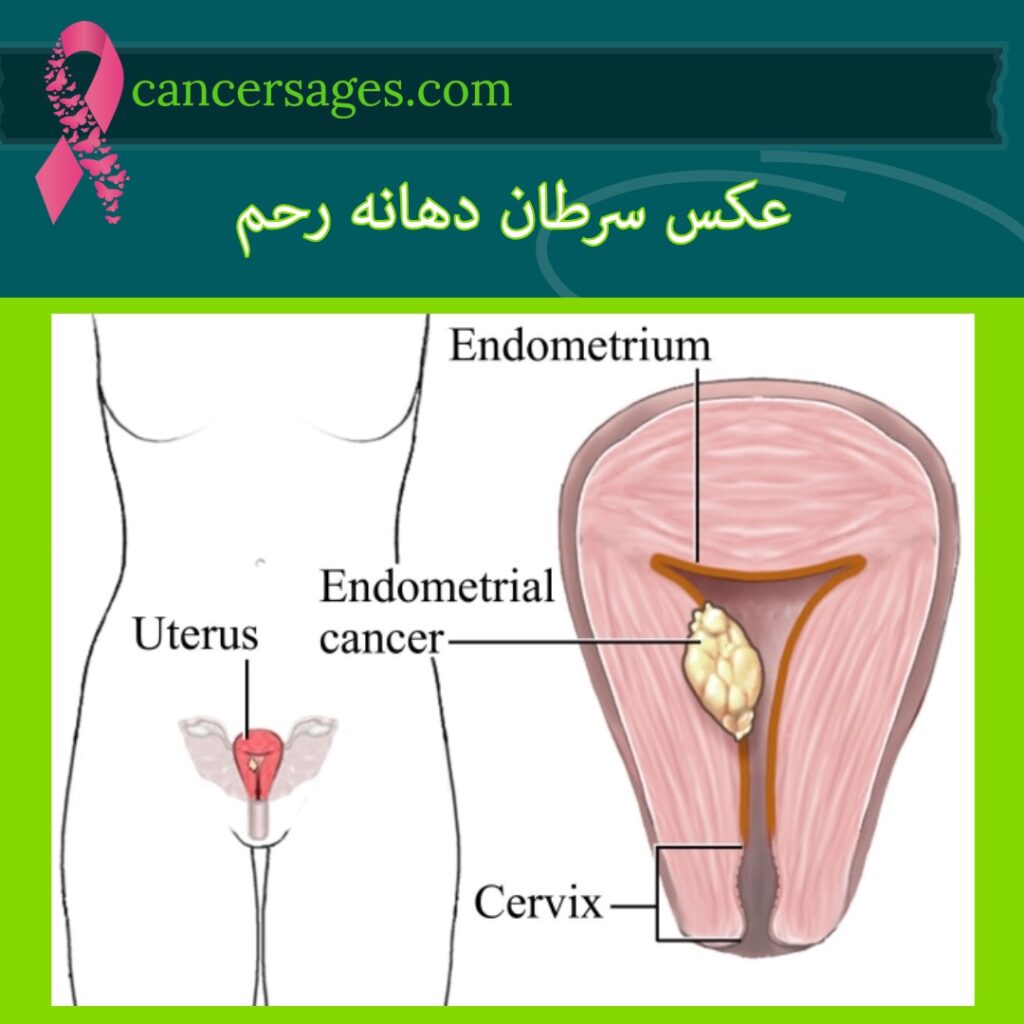 عکس سرطان دهانه رحم