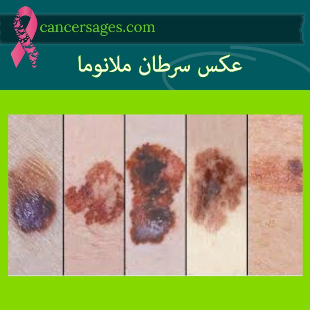 عکس سرطان ملانوما