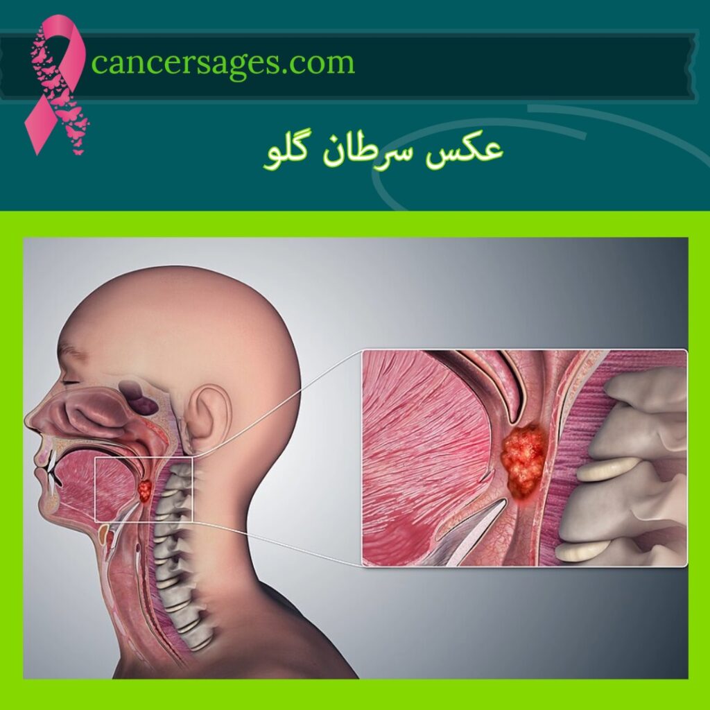 عکس سرطان گلو
