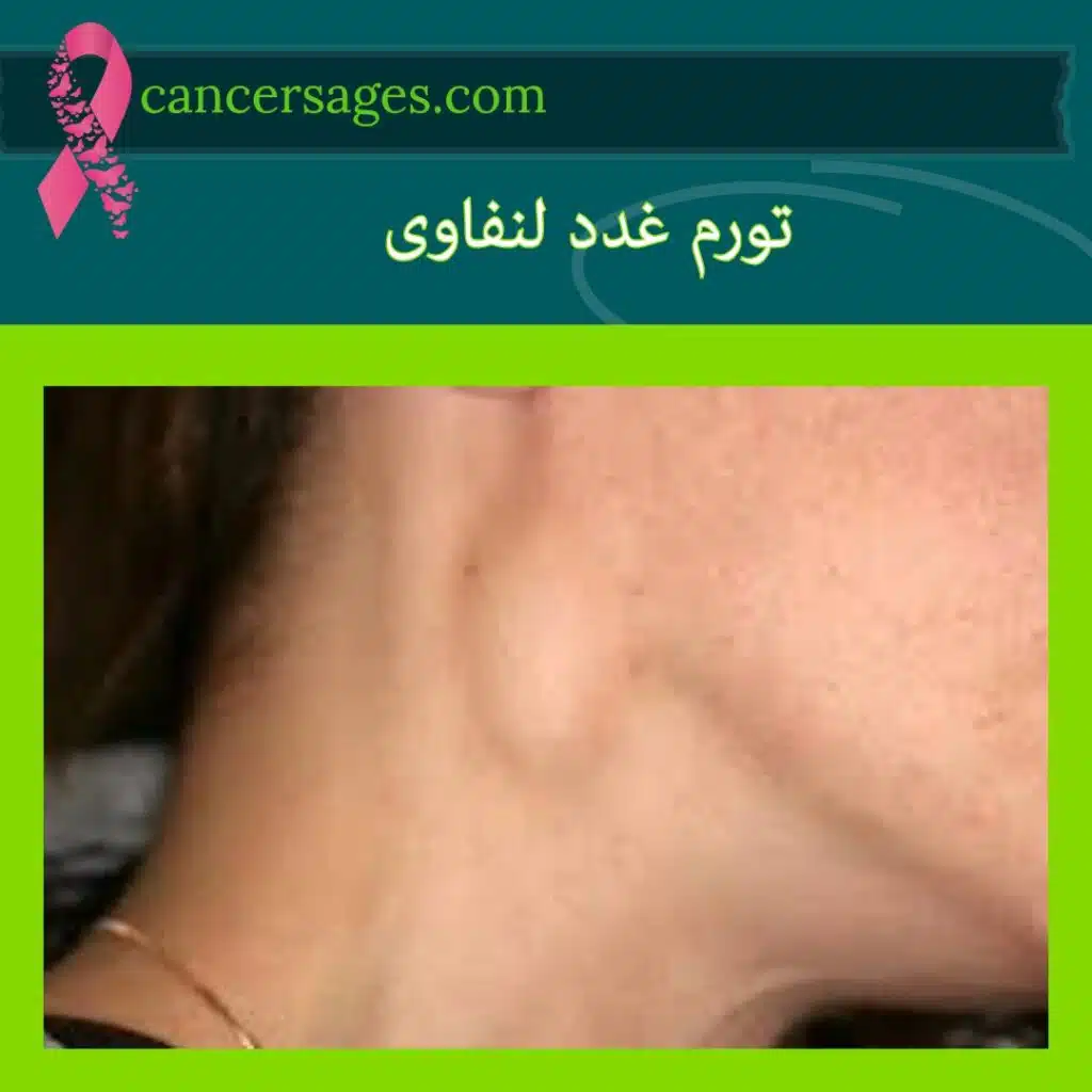 تورم غدد لنفاوی