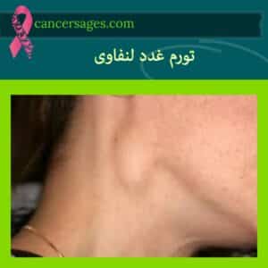 تورم غدد لنفاوی