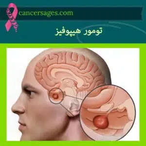 تومور هیپوفیز