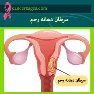 سرطان دهانه رحم