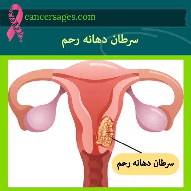 سرطان دهانه رحم
