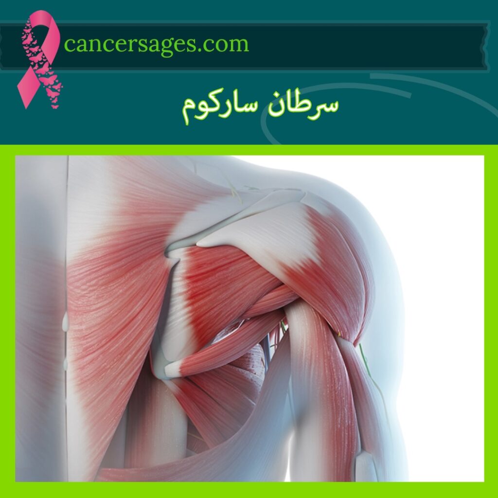 سرطان سارکوم