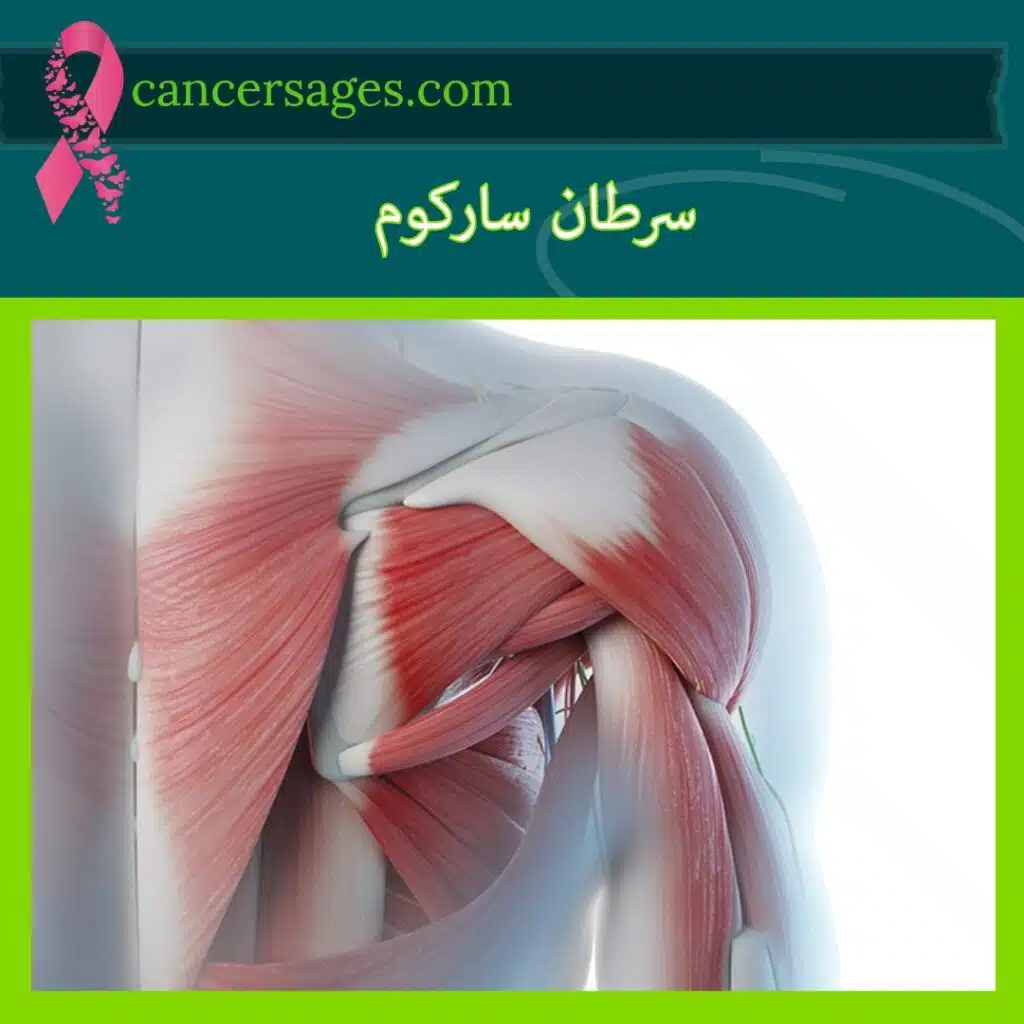 سرطان سارکوم: علائم، تشخیص و درمان قطعی سارکوم 23 سرطان سارکوم