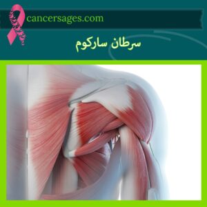 سرطان سارکوم