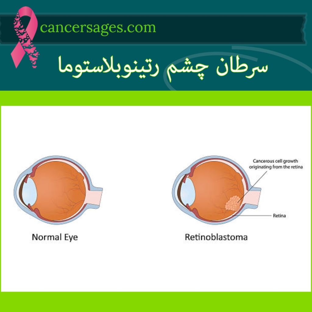 سرطان چشم رتینوبلاستوما