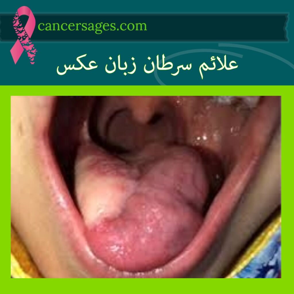 علائم سرطان زبان عکس