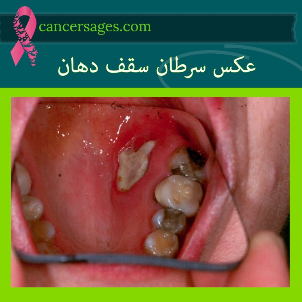 عکس سرطان سقف دهان