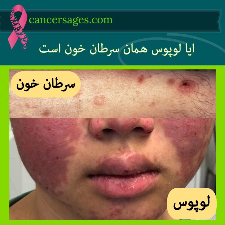 ایا لوپوس همان سرطان خون است