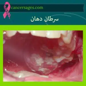 سرطان دهان