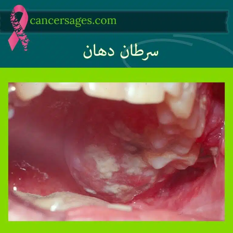 سرطان دهان