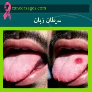 سرطان زبان