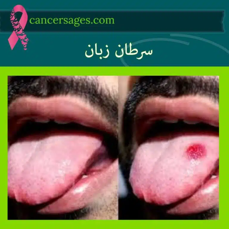 سرطان زبان