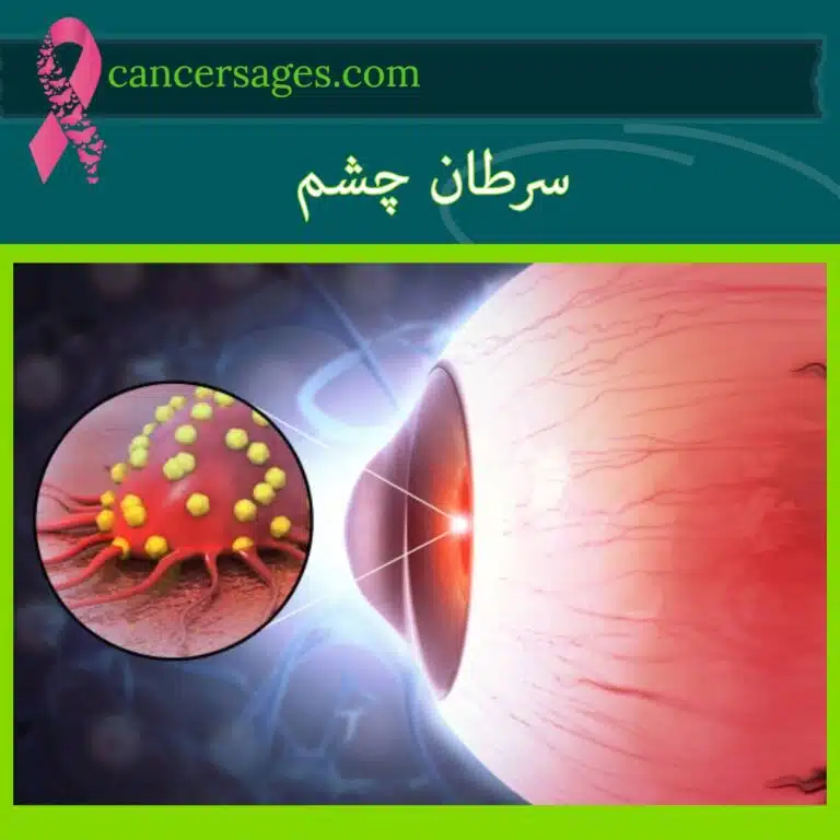 سرطان چشم: علائم، انواع، تشخیص و درمان 1 سرطان چشم