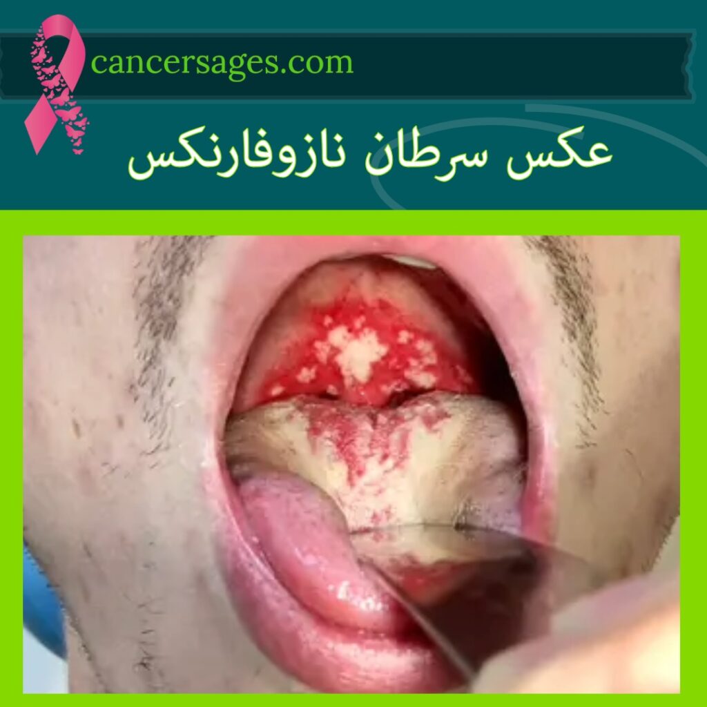 عکس سرطان نازوفارنکس