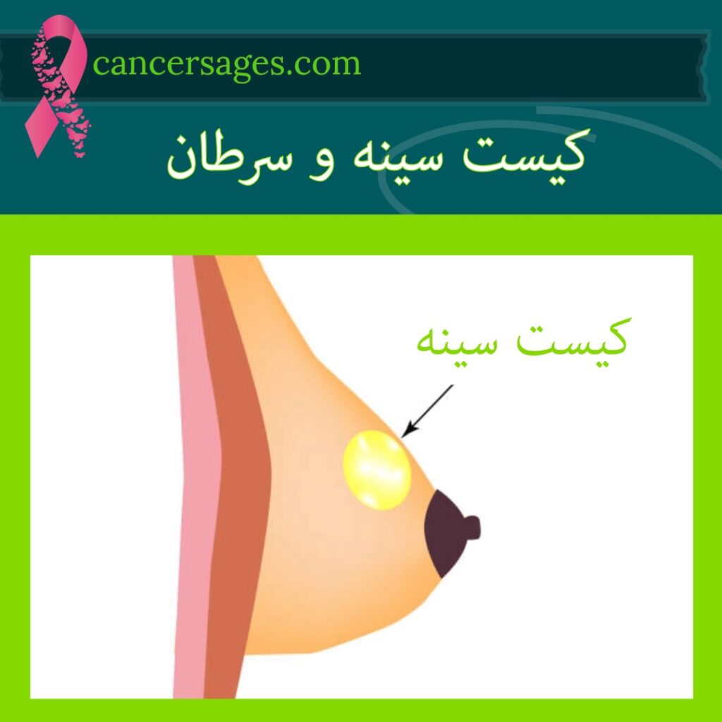 کیست سینه و سرطان
