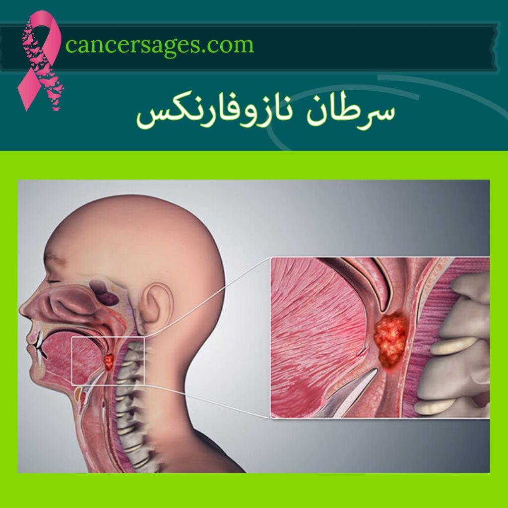 سرطان نازوفارنکس