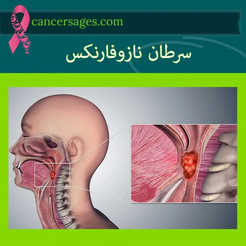 سرطان نازوفارنکس