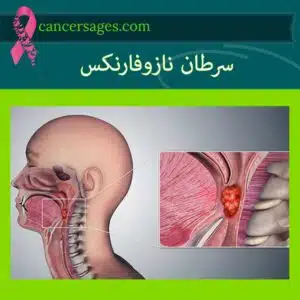 سرطان نازوفارنکس