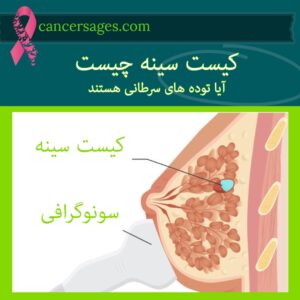 متخصصان سرطان 17 کیست سینه