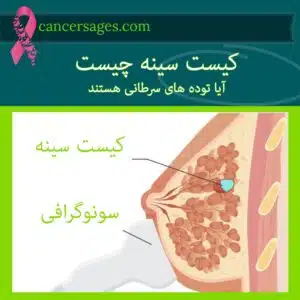 کیست سینه