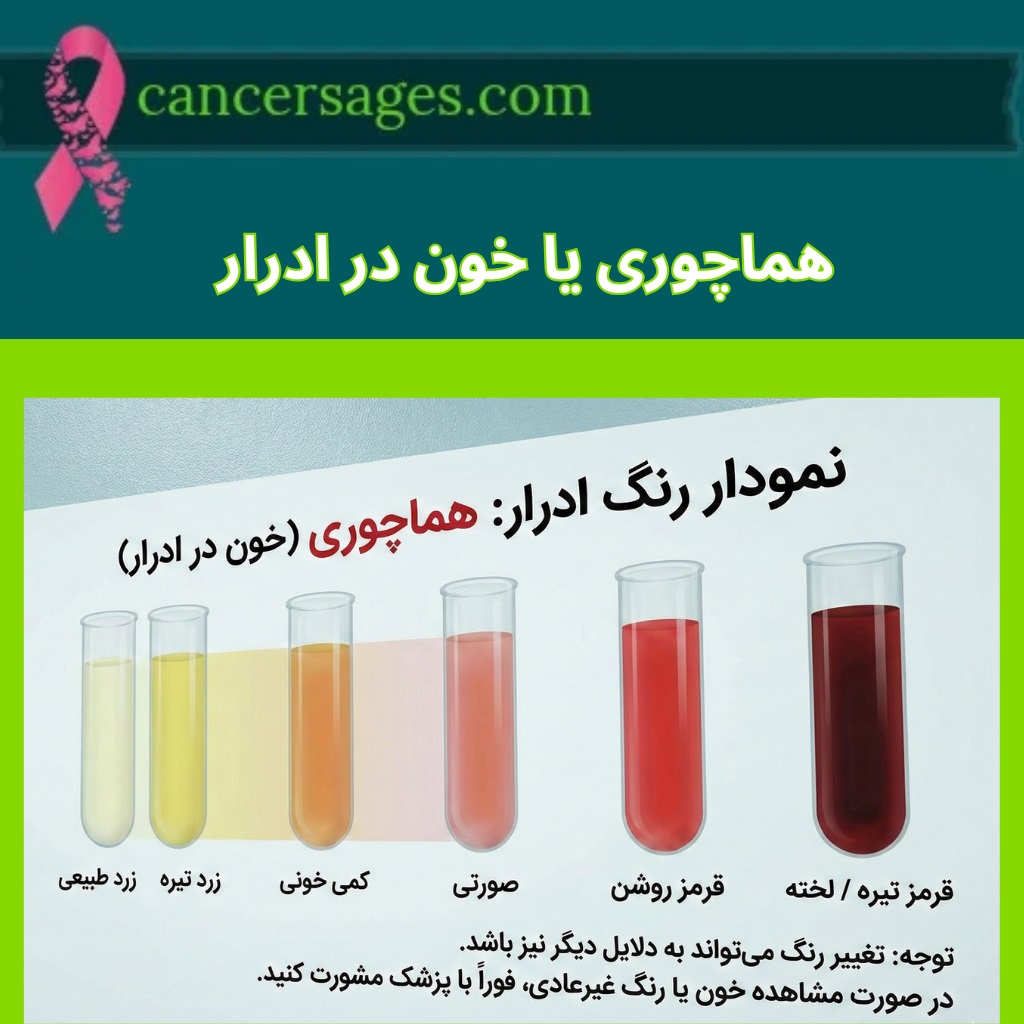 هماچوری یا خون در ادرار