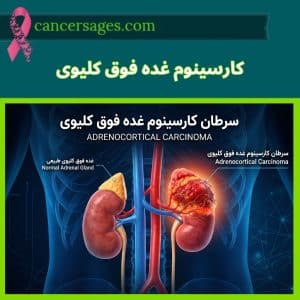 کنسرسیج | مرجع درمان و اطلاعات سرطان 12 سرطان کارسینوم غده فوق کلیوی