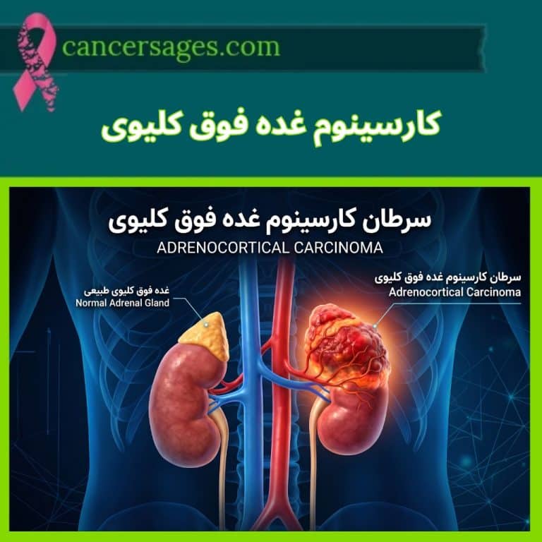 کارسینوم غده فوق کلیوی؛ علائم، تشخیص تومور آدرنال و درمان 2 سرطان کارسینوم غده فوق کلیوی
