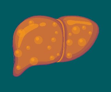سرطان کبد