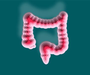 سرطان روده بزرگ